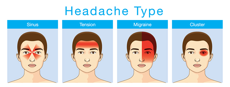 Illustration shows the types of headaches and the areas affected by each.